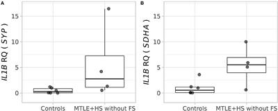 Multidimensional Approach Assessing the Role of Interleukin 1 Beta in Mesial Temporal Lobe Epilepsy